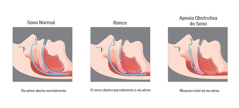 ronco x apnea